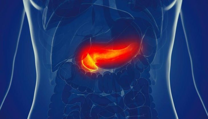 Subclassification Can Tailor Surveillance for Pancreatic Adenocarcinoma ...